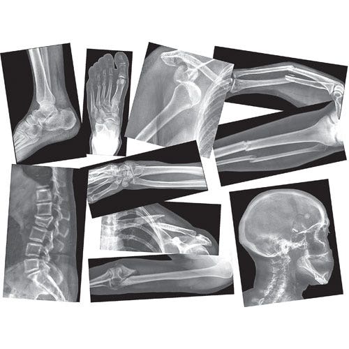 Broken Bones X-Rays